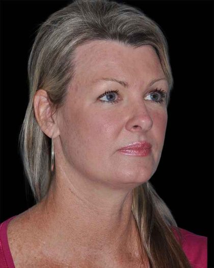 All Me Facelift Before & After Patient #252