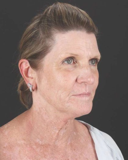 All Me Facelift Before & After Patient #461