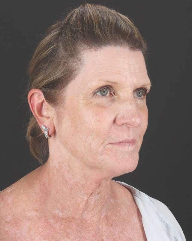 All Me Facelift Before & After Patient #461