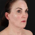 All Me Facelift Before & After Patient #472