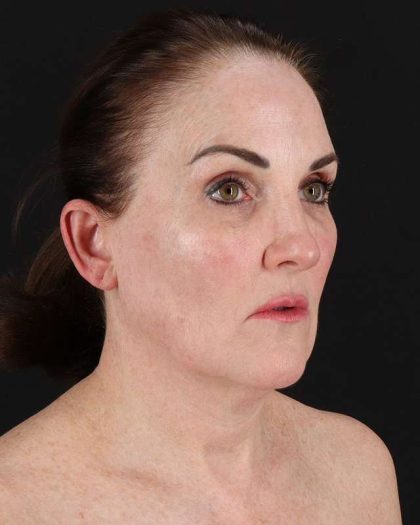 All Me Facelift Before & After Patient #472