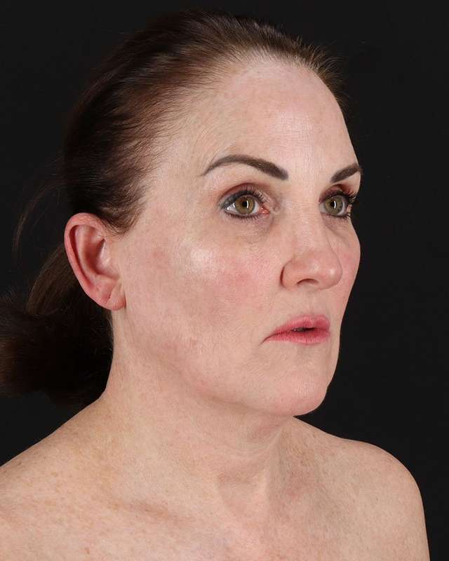 All Me Facelift Before & After Patient #472