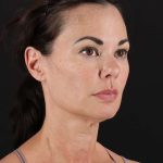 All Me Facelift Before & After Patient #483