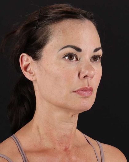 All Me Facelift Before & After Patient #483