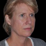 All Me Facelift Before & After Patient #263