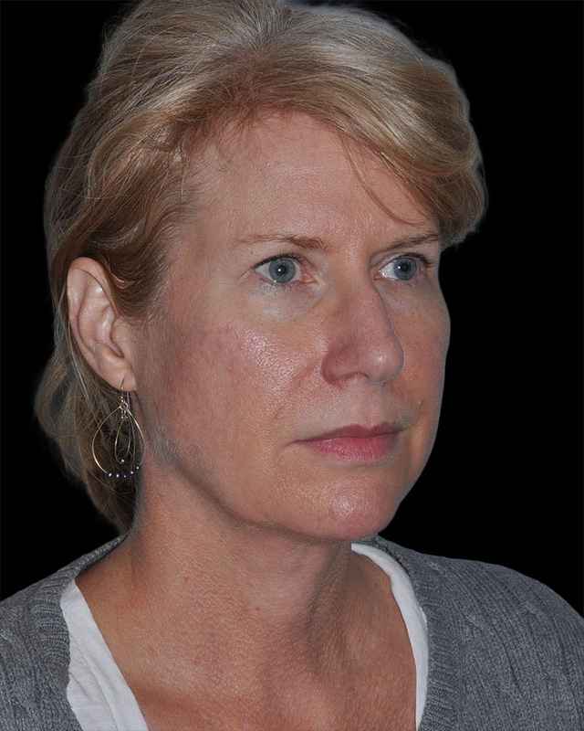 All Me Facelift Before & After Patient #263