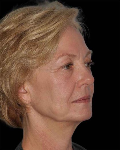 All Me Facelift Before & After Patient #274