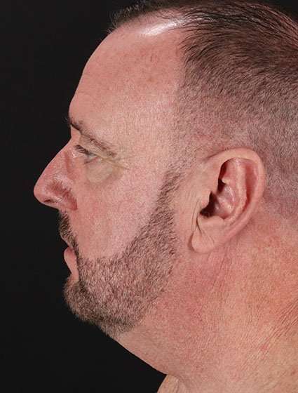 All Me Facelift Before & After Patient #728