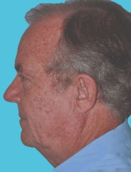 All Me Facelift Before & After Patient #735