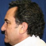 All Me Facelift Before & After Patient #742
