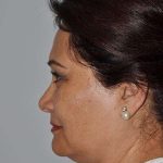 All Me Facelift Before & After Patient #749