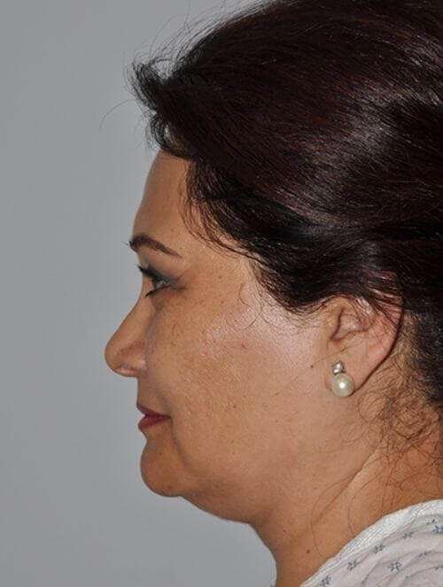 All Me Facelift Before & After Patient #749