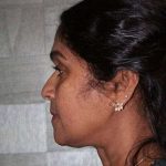 All Me Facelift Before & After Patient #756