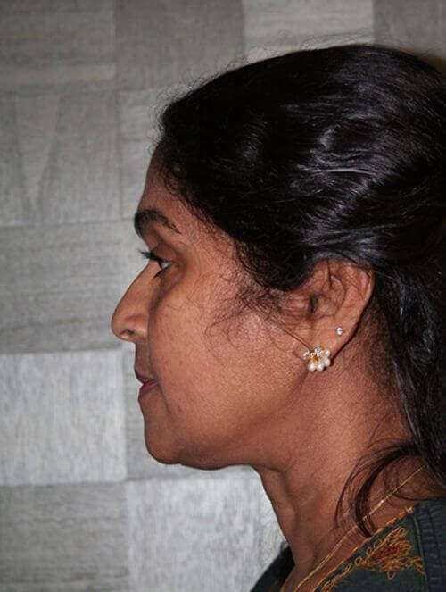 All Me Facelift Before & After Patient #756