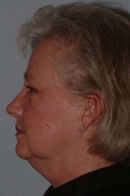 All Me Facelift Before & After Patient #763