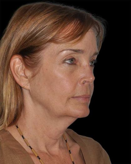 All Me Facelift Before & After Patient #297