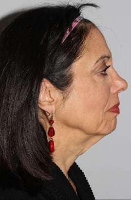 All Me Facelift Before & After Patient #770