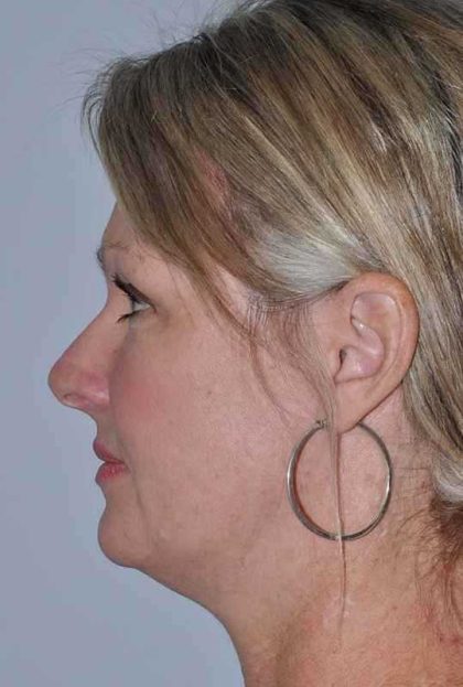 All Me Facelift Before & After Patient #781