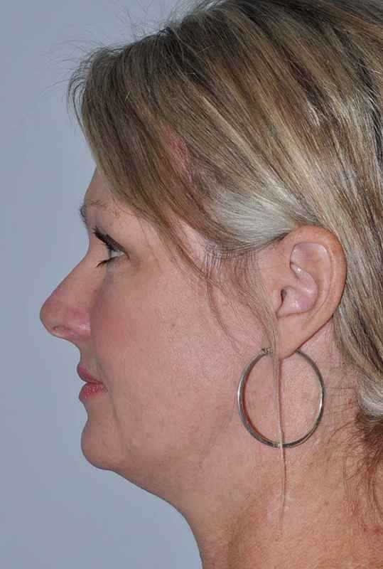 All Me Facelift Before & After Patient #781