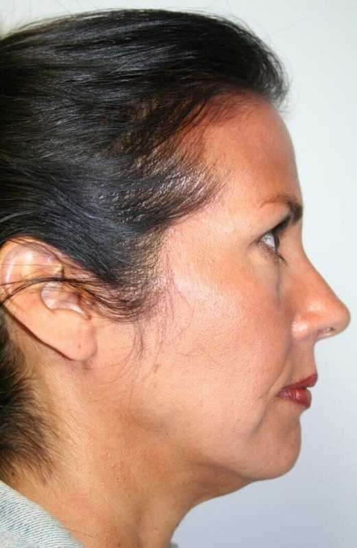 All Me Facelift Before & After Patient #786