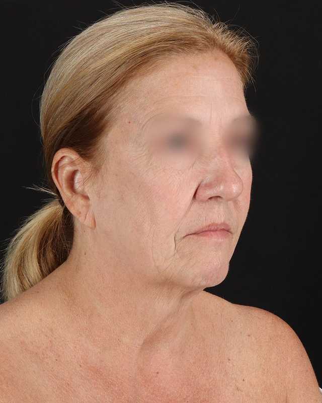 All Me Facelift Before & After Patient #320
