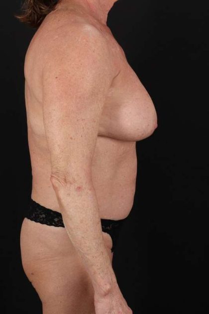 All Me Augmentation Before & After Patient #1190