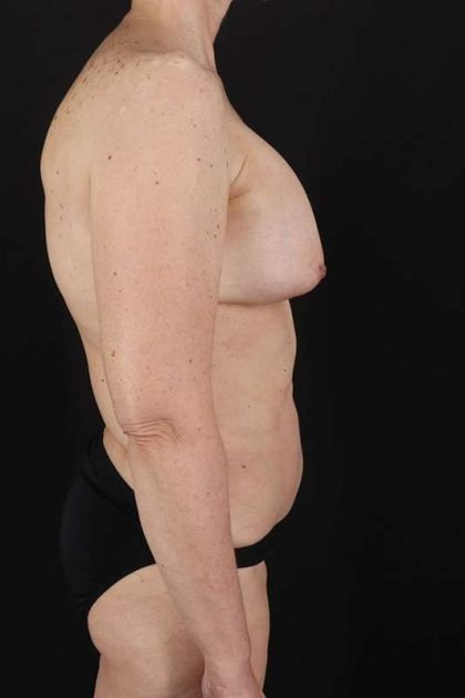 All Me Augmentation Before & After Patient #1197
