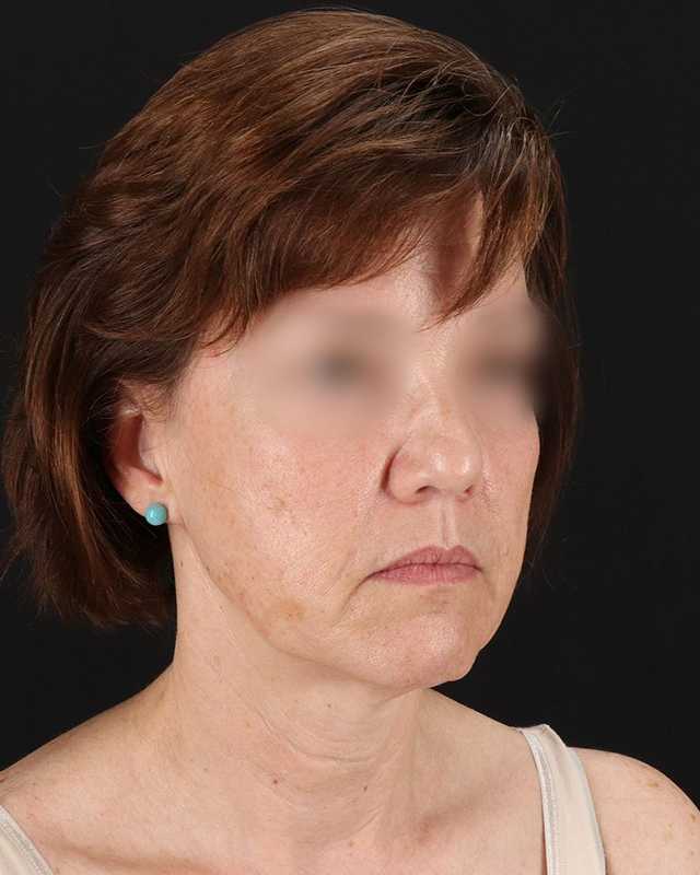All Me Facelift Before & After Patient #229