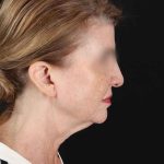 All Me Facelift Before & After Patient #240