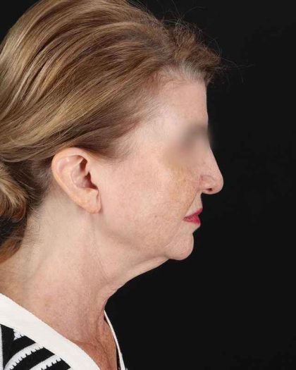 All Me Facelift Before & After Patient #240