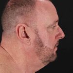 All Me Facelift Before & After Patient #343