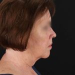 All Me Facelift Before & After Patient #354