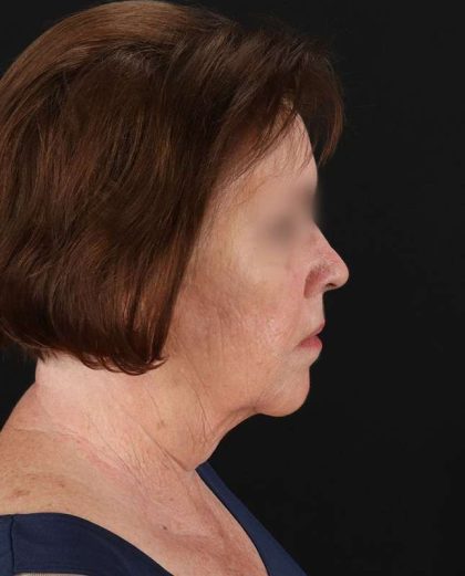 All Me Facelift Before & After Patient #354