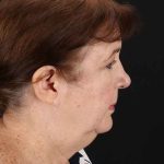 All Me Facelift Before & After Patient #366