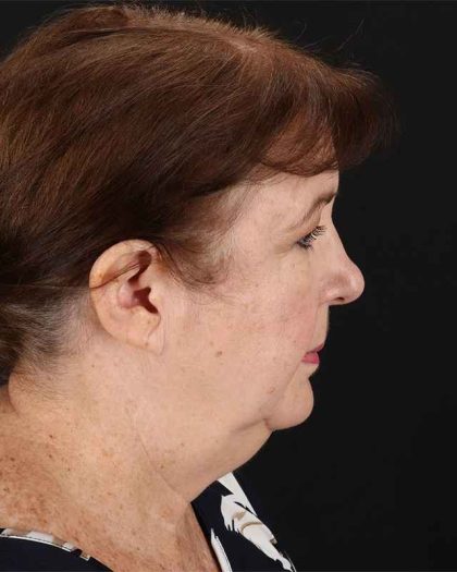 All Me Facelift Before & After Patient #366