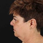 All Me Facelift Before & After Patient #373