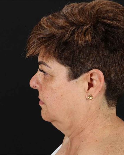 All Me Facelift Before & After Patient #373