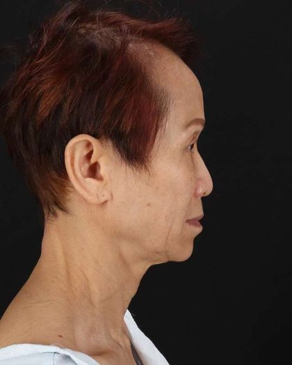 All Me Facelift Before & After Patient #395