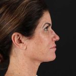 All Me Facelift Before & After Patient #406