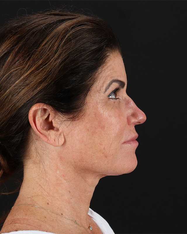 All Me Facelift Before & After Patient #406