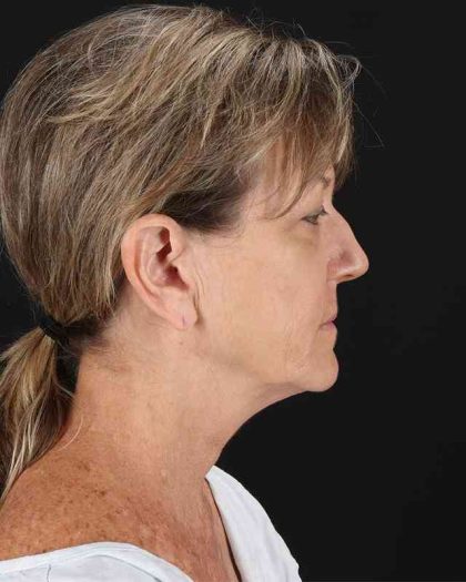 All Me Facelift Before & After Patient #418