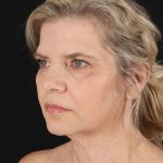All Me Facelift Before & After Patient #428