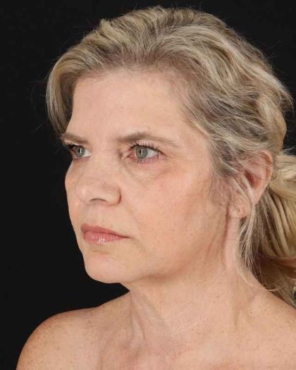 All Me Facelift Before & After Patient #428