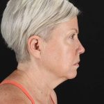 All Me Facelift Before & After Patient #439