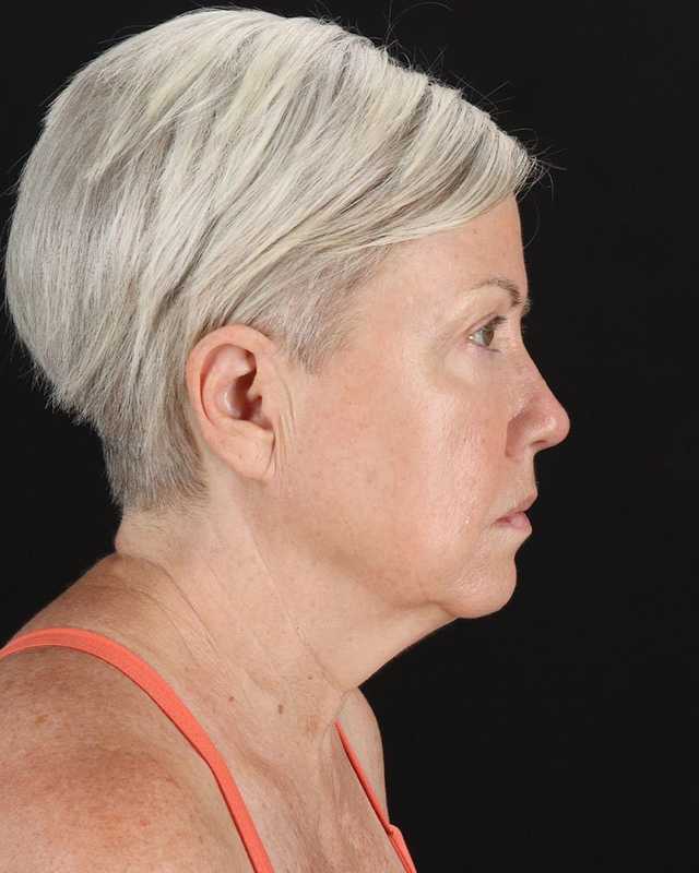 All Me Facelift Before & After Patient #439