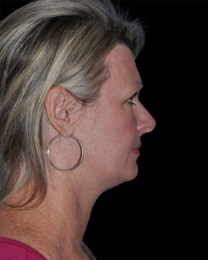 All Me Facelift Before & After Patient #252