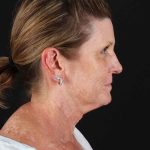 All Me Facelift Before & After Patient #461