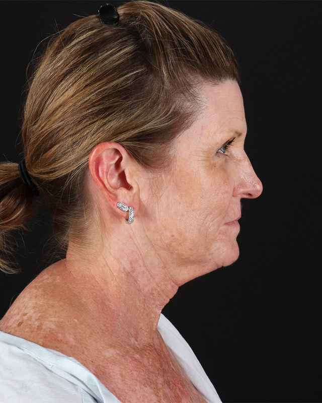 All Me Facelift Before & After Patient #461