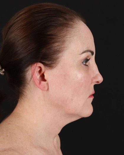 All Me Facelift Before & After Patient #472