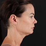 All Me Facelift Before & After Patient #483